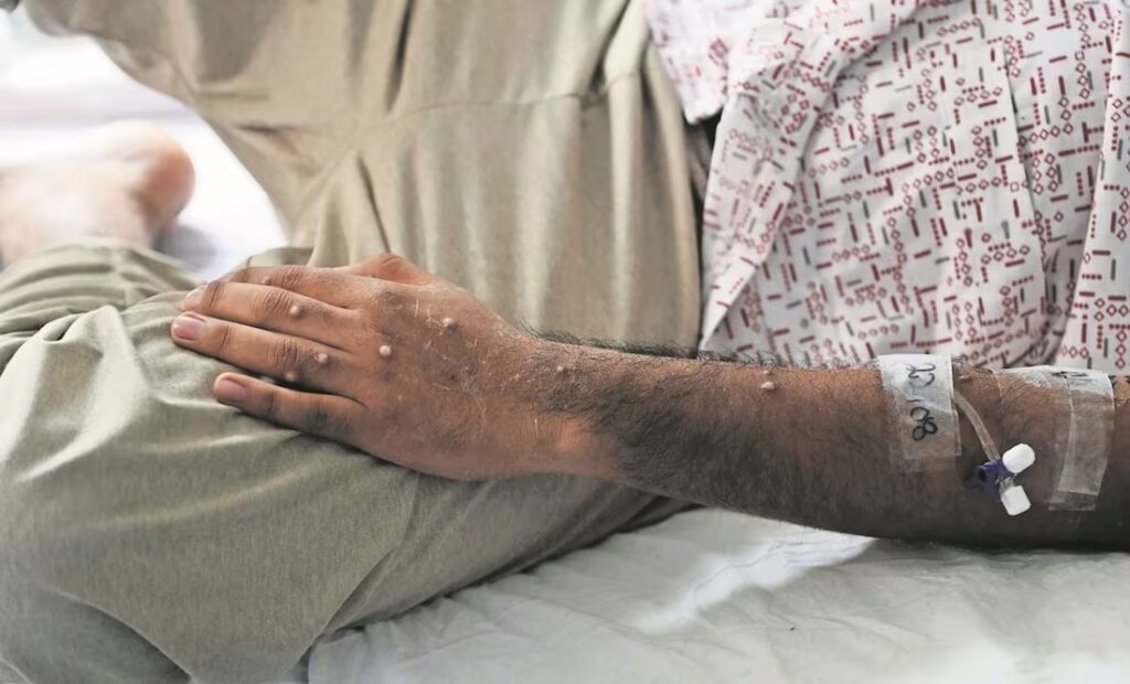 Paciente atendido por Mpox. La OMS declara nuevamente el mpox como emergencia internacional de salud. Foto: EFE.