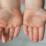 Ante un brote de sarampión, se emitieron recomendaciones de salud