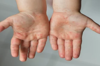 Ante un brote de sarampión, se emitieron recomendaciones de salud