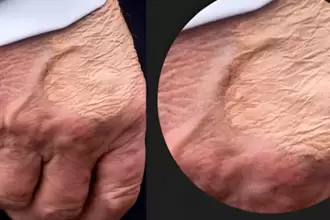 Donald Trump habría presentado algunos moretones en una de sus manos e hinchazón en piernas, derivado de la insuficiencia venosa que padece