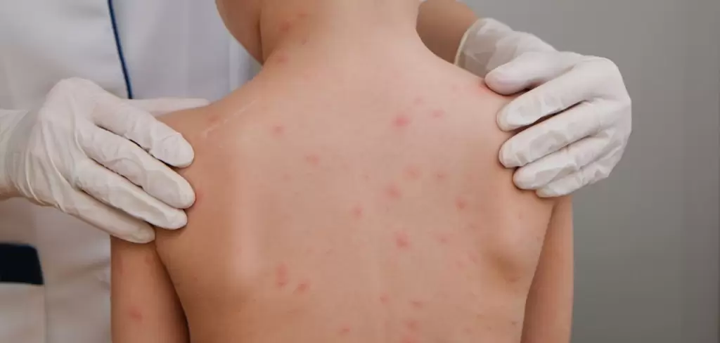 Resurge el sarampión en México, y Chihuahua se posiciona como el foco de alerta. Foto Consultor salud