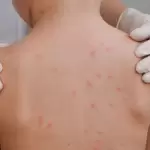 Resurge el sarampión en México, y Chihuahua se posiciona como el foco de alerta. Foto Consultor salud