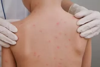 Resurge el sarampión en México, y Chihuahua se posiciona como el foco de alerta. Foto Consultor salud