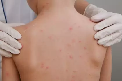 Resurge el sarampión en México, y Chihuahua se posiciona como el foco de alerta. Foto Consultor salud