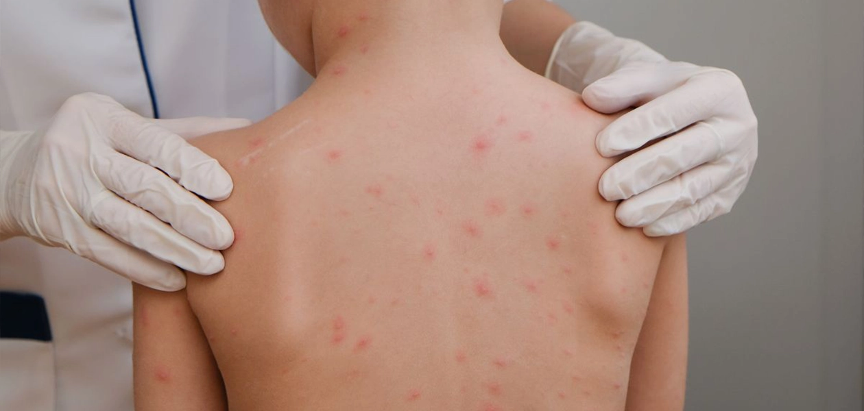 Resurge el sarampión en México, y Chihuahua se posiciona como el foco de alerta. Foto Consultor salud