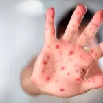 Imagen ilustrativa a un paciente con Sarampión. Foto: JLMNoticias / Especial.