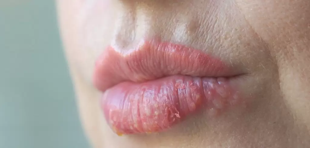 Alergia en labios