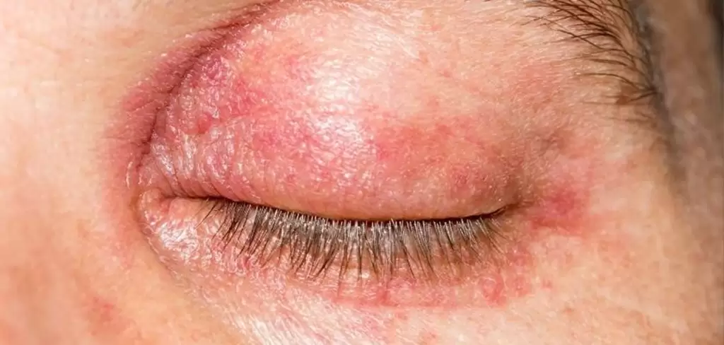 Alergia en párpados