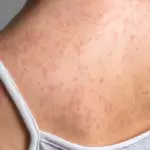 Sarampión: erupción cutánea y fiebre alta, principales síntomas de la enfermedad viral