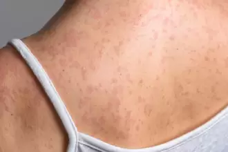 Sarampión: erupción cutánea y fiebre alta, principales síntomas de la enfermedad viral