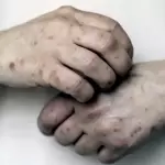 El brote de sarampión en México supera los 9 mil casos confirmados y mantiene activa la campaña nacional de vacunación.