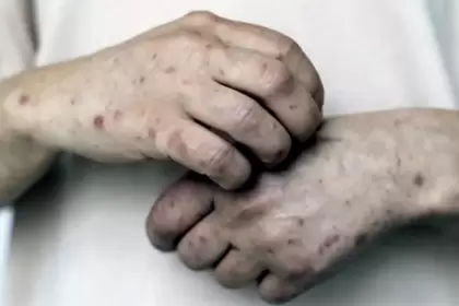 El brote de sarampión en México supera los 9 mil casos confirmados y mantiene activa la campaña nacional de vacunación.